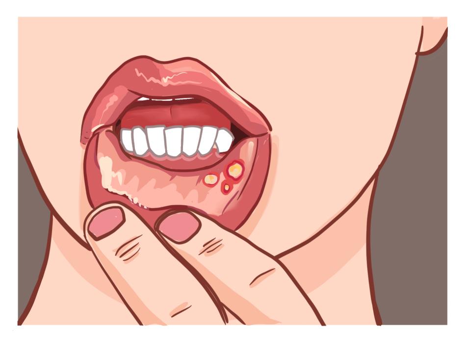 口腔溃疡.jpg