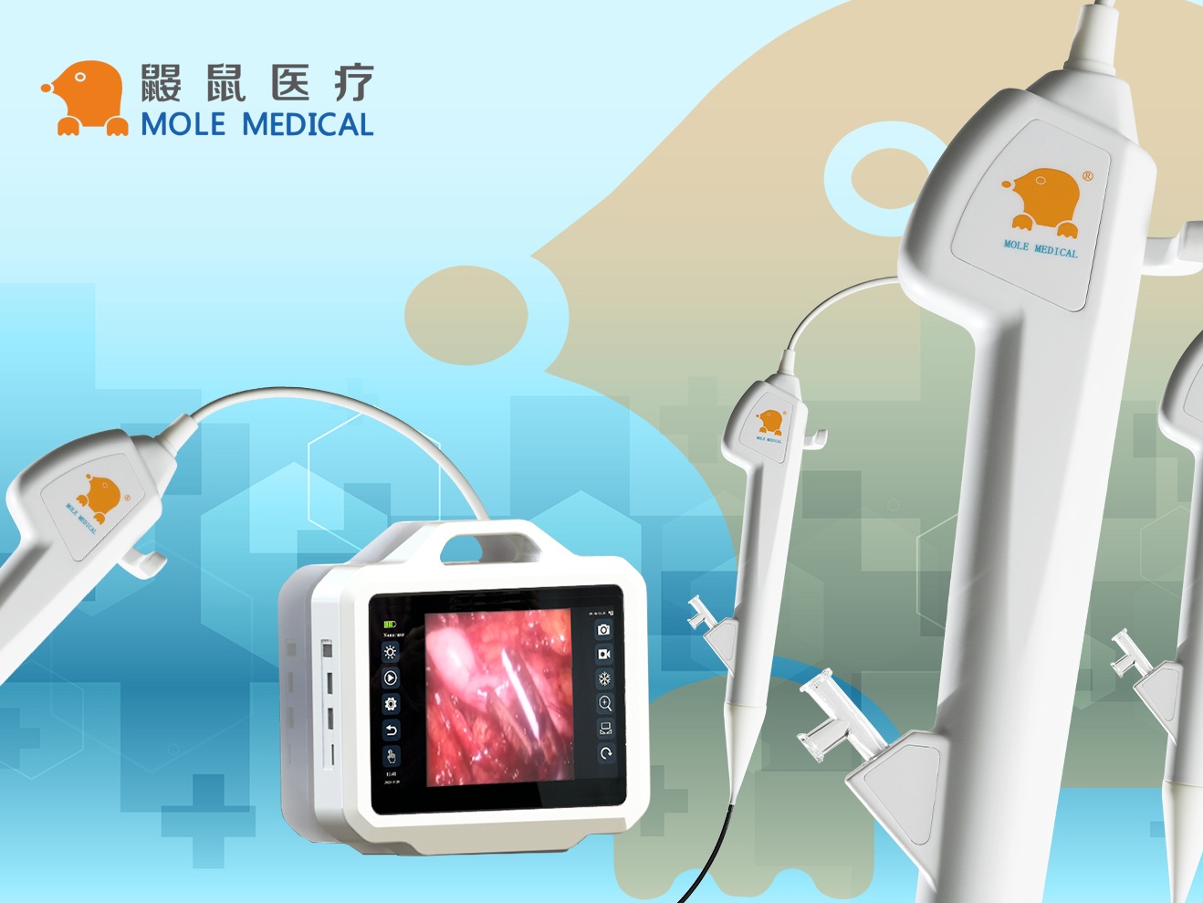 一次性輸尿管軟鏡聯合可彎曲負壓吸引鞘治療復雜性腎結石的療效分析 (1).jpg