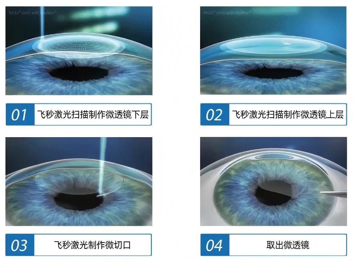全飞秒手术方式.jpg